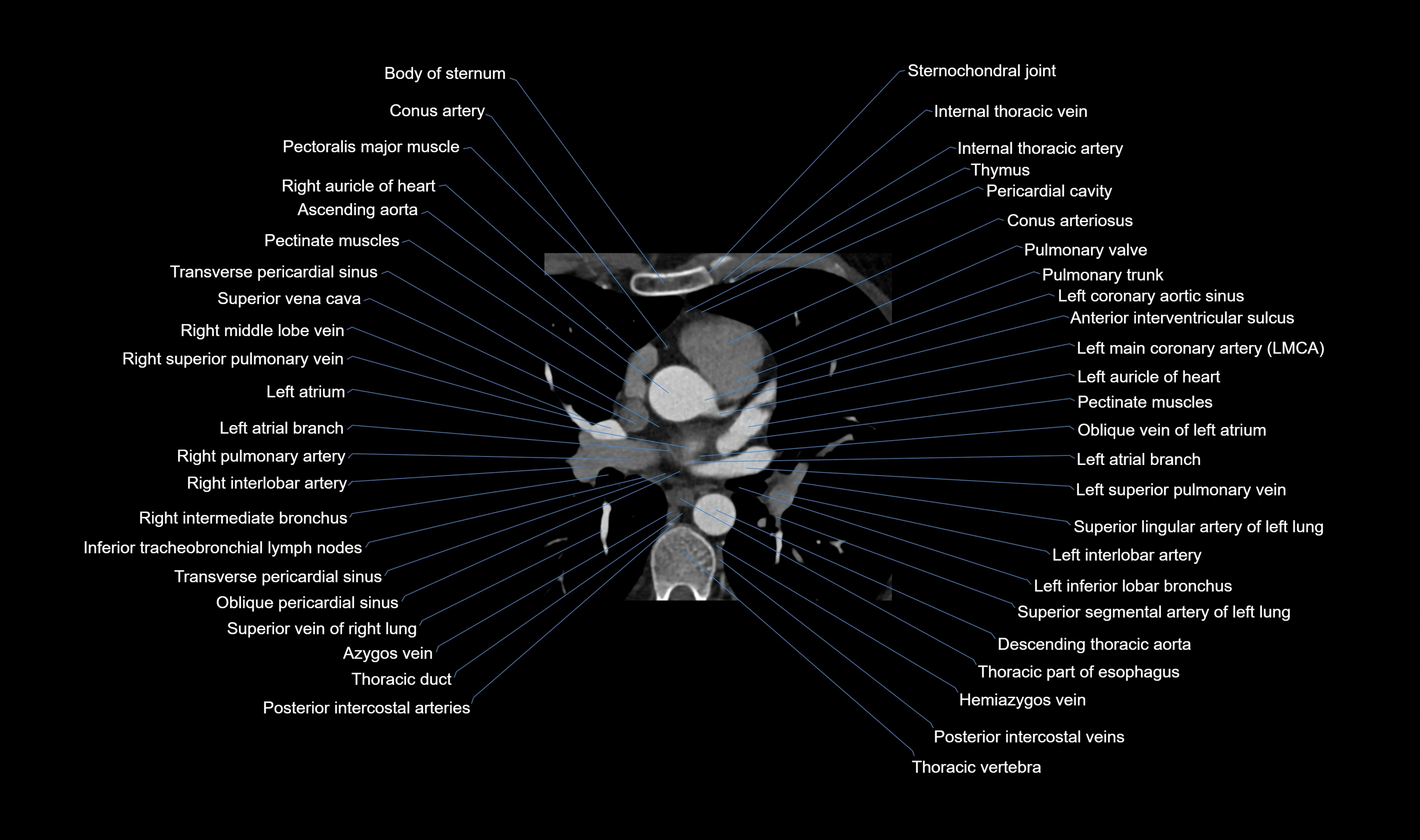 CT heart (coronary angiogram) axial view cross sectional anatomy labelled radiology image-00020.webp